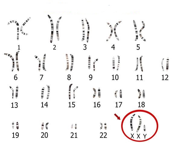درمان سندروم کلاین فلتر و الگوی توارث آن | ژن آزما