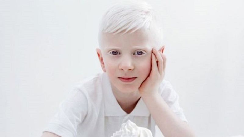 مشکلات افراد زال را بشناسید! | بهترین آزمایشگاه ژنتیک اصفهان