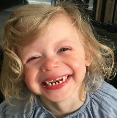 سندروم نشانگان ویلیامز چیست؟ | آزمایشگاه ژنتیک اصفهان