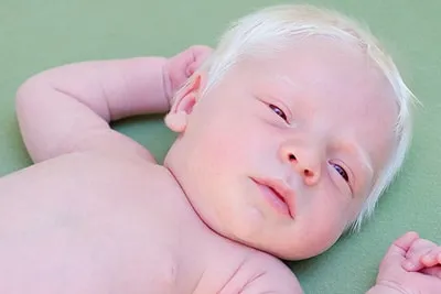 زالی -یا-آلبینیسم