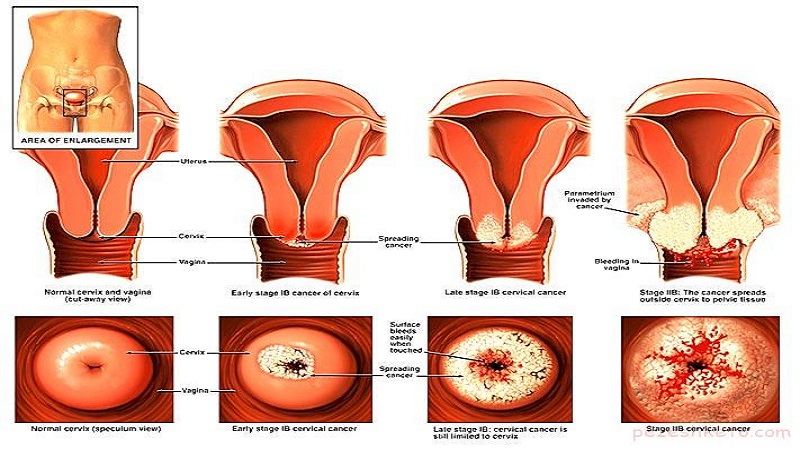 انواع سرطان دهانه رحم | آزمایشگاه ژنتیک اصفهان
