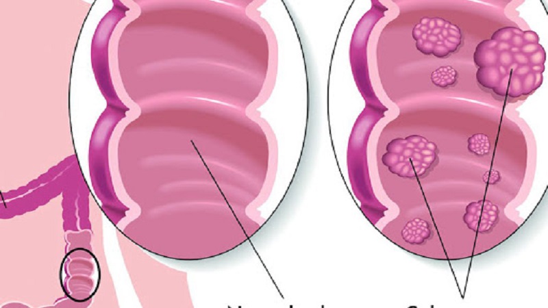 سرطان های ارثی روده بزرگ | آزمایشگاه ژن آزما