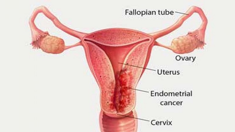 علائم سرطان گردن رحم | آزمایشگاه ژن آزما