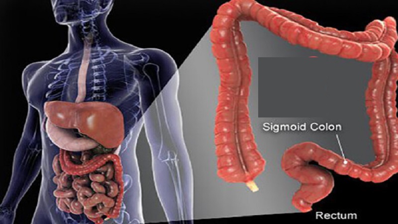 روش های درمان و تشخیص سرطان کولورکتال CRC | آزمایشگاه ژنتیک اصفهان