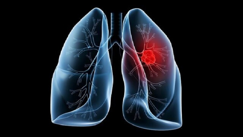 سرطان ریه سلول بزرگ (NSCLC) | بهترین آزمایشگاه ژنتیک اصفهان