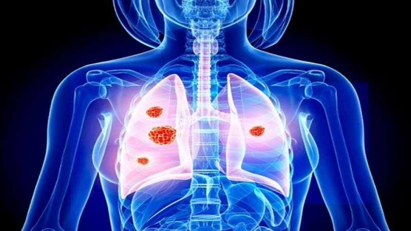 سرطان ریه سلول کوچک (SCLC) | بهترین آزمایشگاه ژنتیک اصفهان