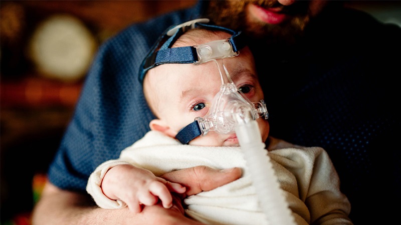 سندرم پاتو (Patau) یا تریزومی 13 | بهترین آزمایشگاه ژنتیک اصفهان