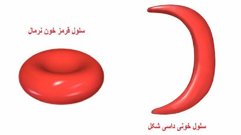 علائم کم خونی سلول داسی | بهترین آزمایشگاه ژنتیک اصفهان