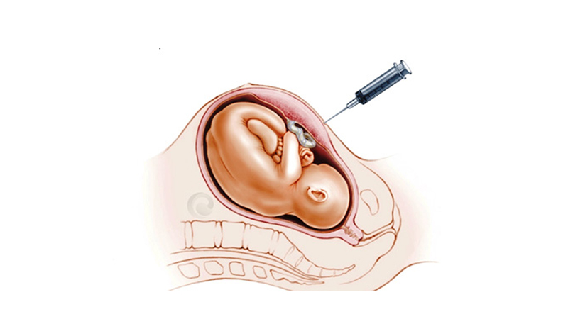 کاربرد آمینوسنتز در خانمهای باردار | بهترین آزمایشگاه ژنتیک اصفهان