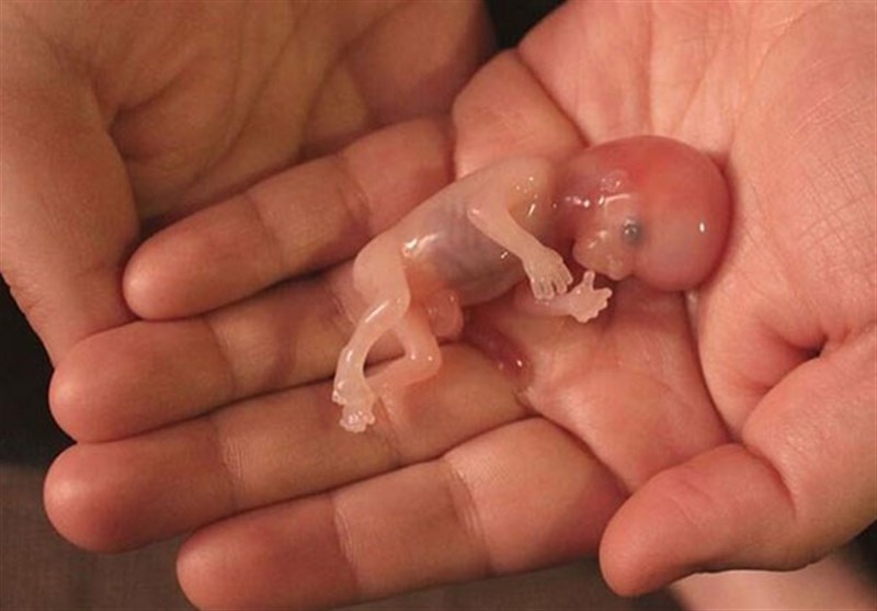 تصویر جنین سقط شده