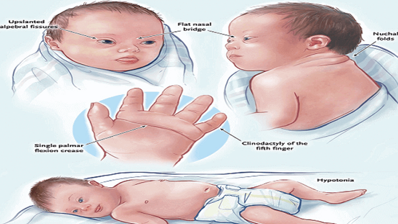 تشخیص جا به جایی کروموزوم در جنین | بهترین آزمایشگاه ژنتیک اصفهان