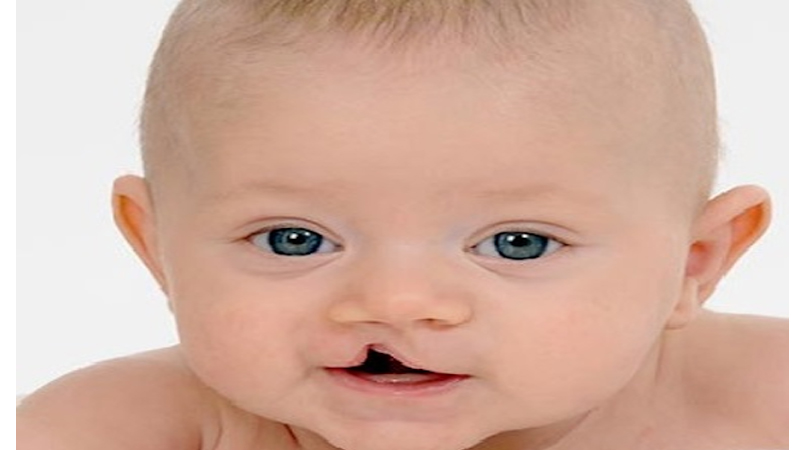 سندروم پاتو یا تریزومی 13 | آزمایش ژنتیک اصفهان