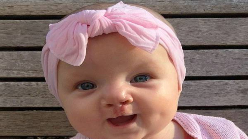 نکاتی در مورد شکاف لب | مشاوره ژنتیک اصفهان