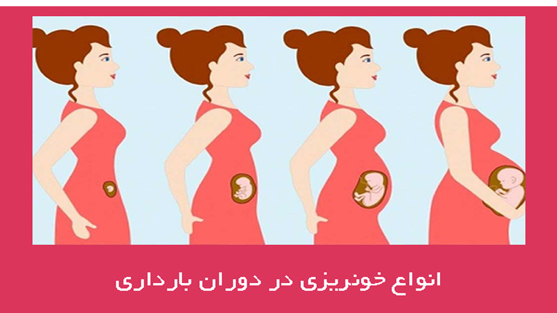 دلایل خونریزی در بارداری | مشاوره ژنتیک اصفهان