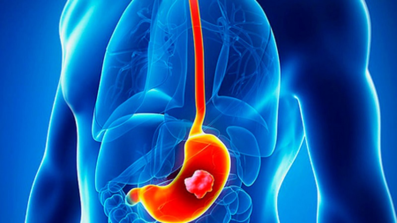 تشخیص سرطان معده | مشاور ژنتیک اصفهان