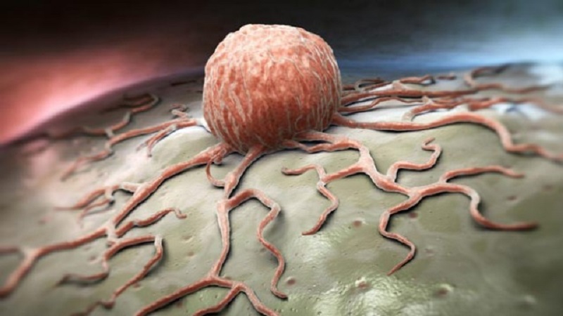 سرطان پروستات و انواع آن | بهترین آزمایشگاه ژنتیک اصفهان