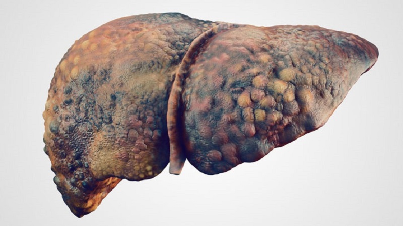 عوارض سرطان کبد | مشاور ژنتیک اصفهان