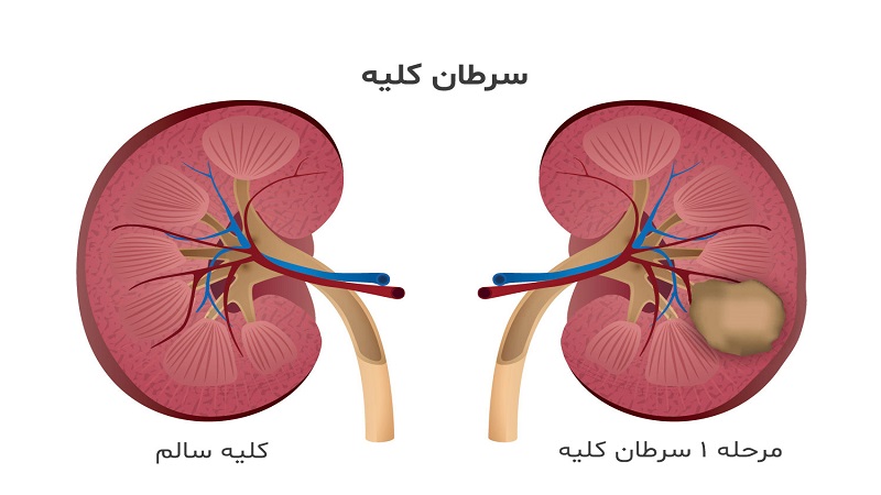 درمان سرطان کلیه | مشاور ژنتیک اصفهان