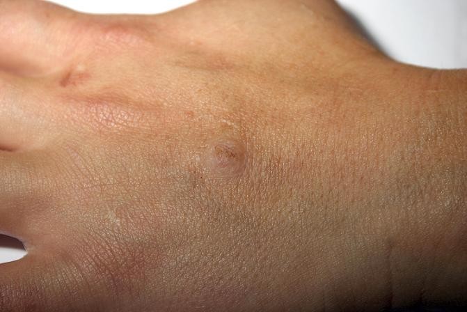 ابتلا به سندروم کاودن