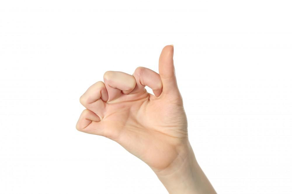 سندرم مارفان چیست