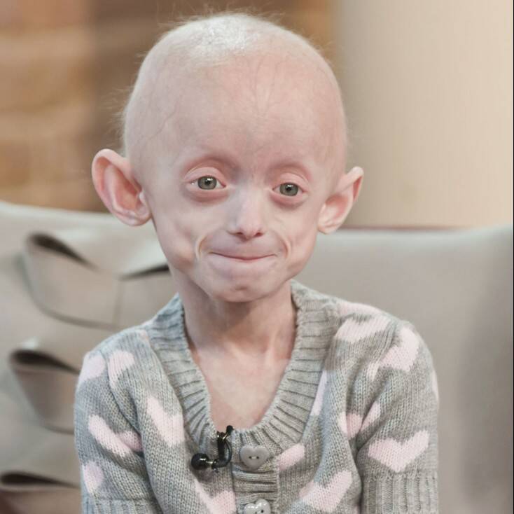 درمان سندرم پیری زودرس | ژن آزما