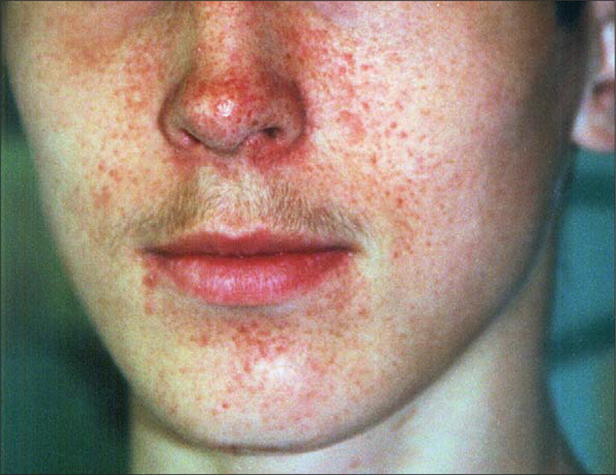 علت توبروس اسکلروز