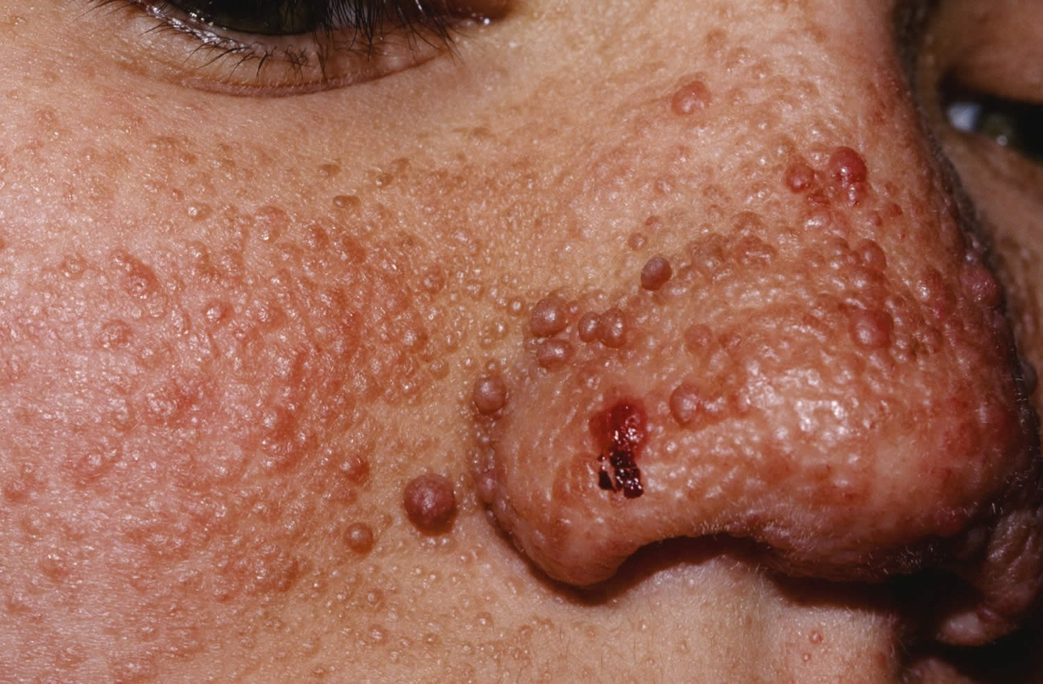 علت توبروس اسکلروز