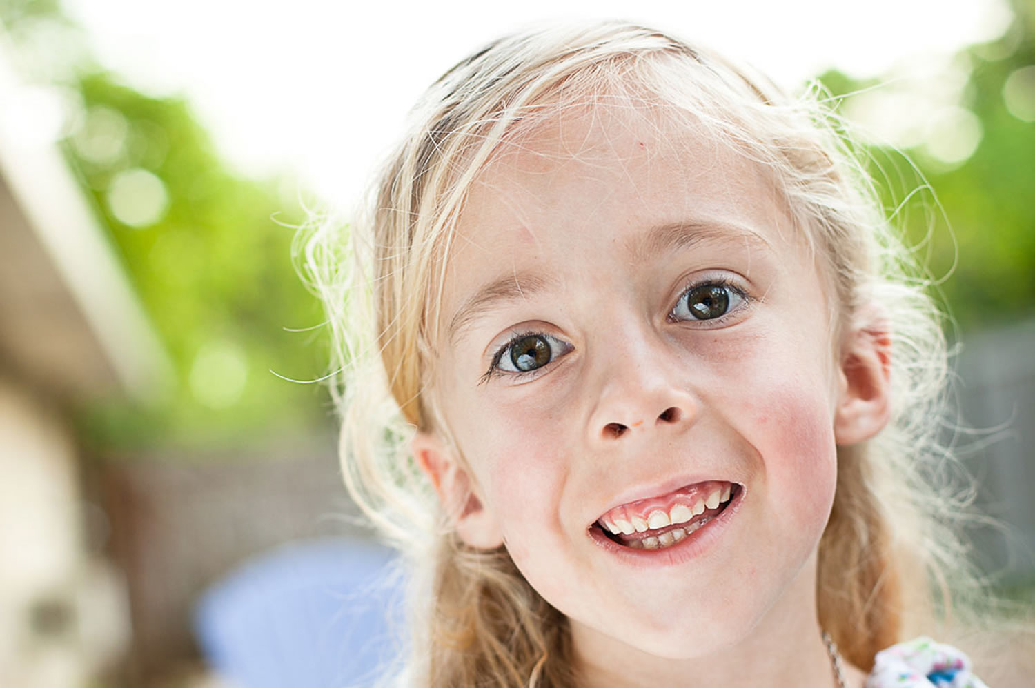 علائم سندروم پرادرویلی