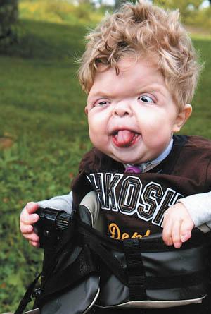 علایم سندروم پرادرویلی