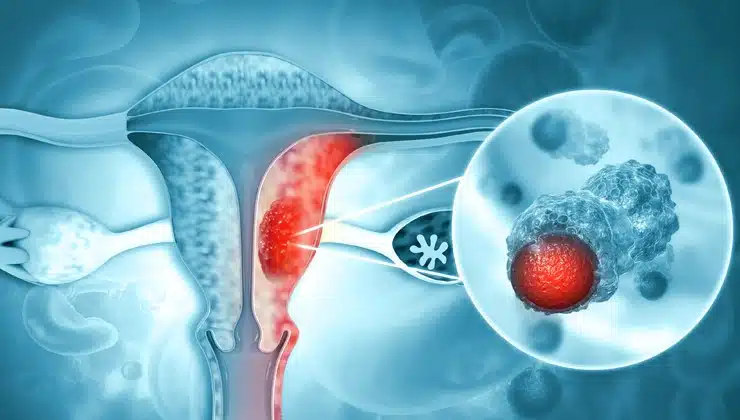 سرطان دهانه رحم