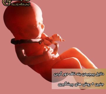 پیچیدن بند ناف دور گردن جنین