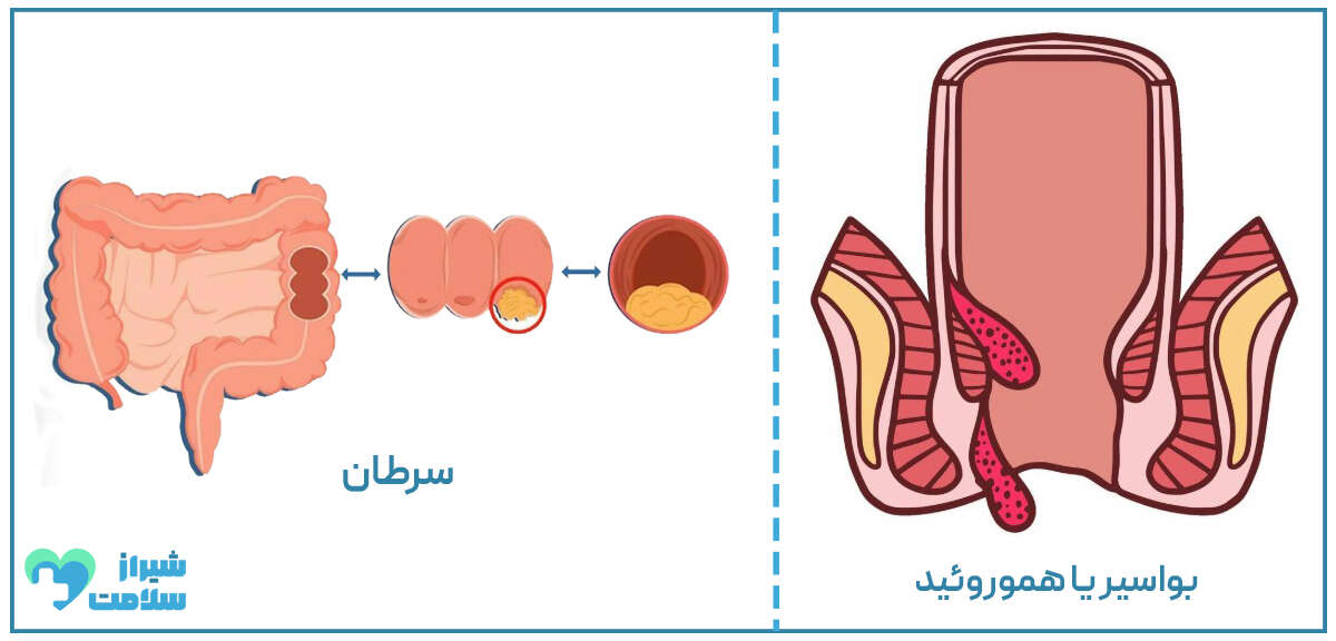 آیا بواسیر باعث سرطان میشود | ژن آزما