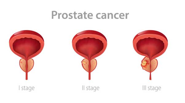 طول عمر سرطان پروستات بدخیم | ژن آزما