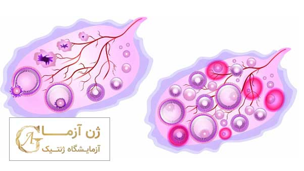 علائم سرطان تخمدان در زنان | ژن آزما