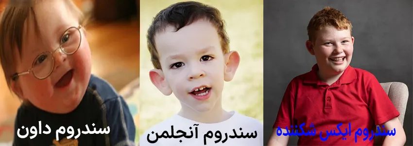 سندرم های ژنتیکی / کروموزومی