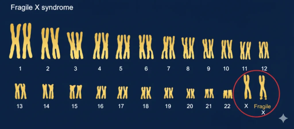 سندرم ایکس شکننده